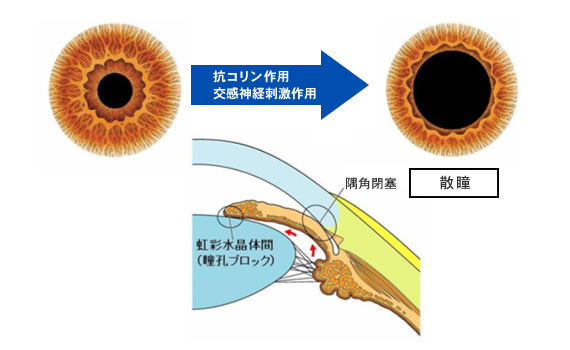 狭隅角における散瞳による眼圧上昇機序