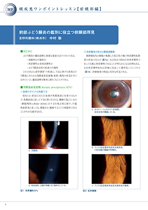 前部ぶどう膜炎の鑑別に役立つ前眼部所見