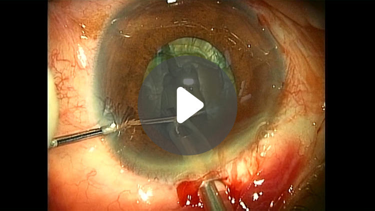 白内障手術と眼内レンズ ―スタンダードテクニックとその注意点―