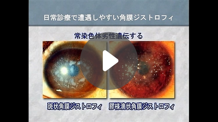 角膜ジストロフィの鑑別診断と治療