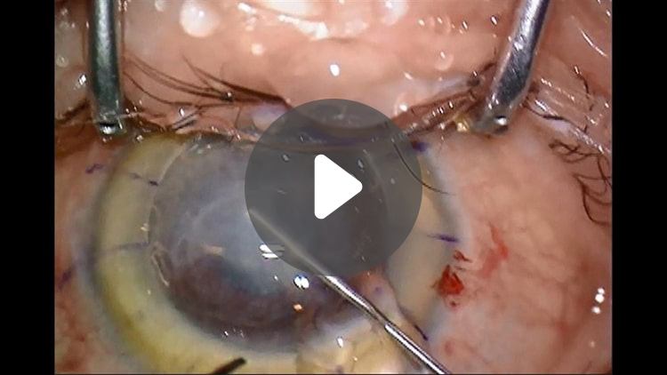 Deep anterior lamellar keratoplasty（DALK）