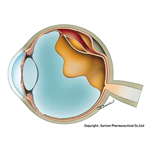 眼球断面図(膜組織の剥離)