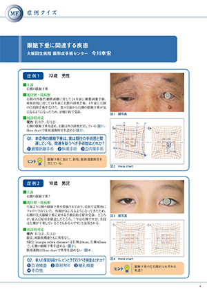 眼瞼下垂に関連する疾患